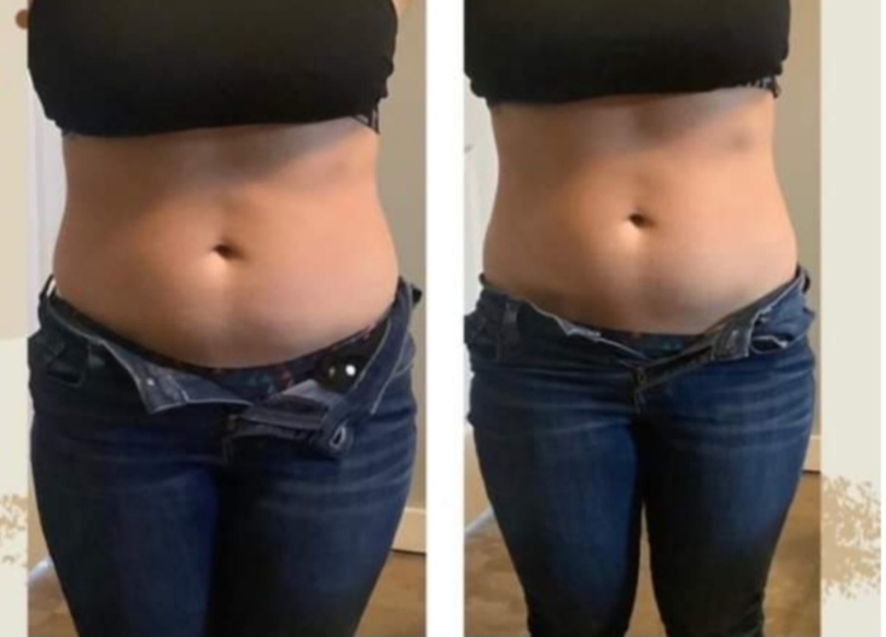 Body Sculpting
