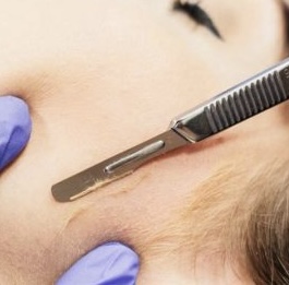 Dermaplaning