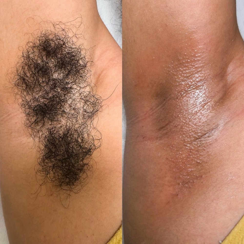 Under Arm Hair Removal at Amethyst Spa in Omaha, NE