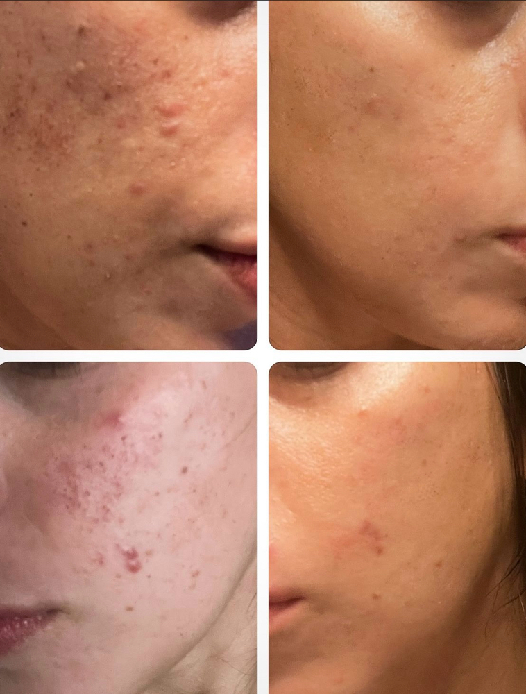 V-IPL Acne Clearance