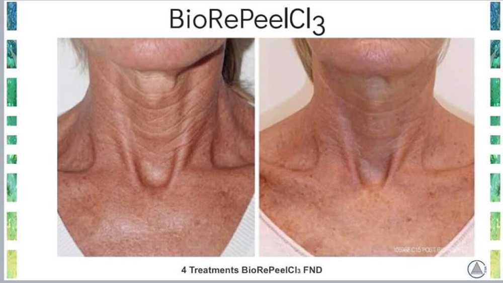 BODY BIOREPEEL + Dermaplane