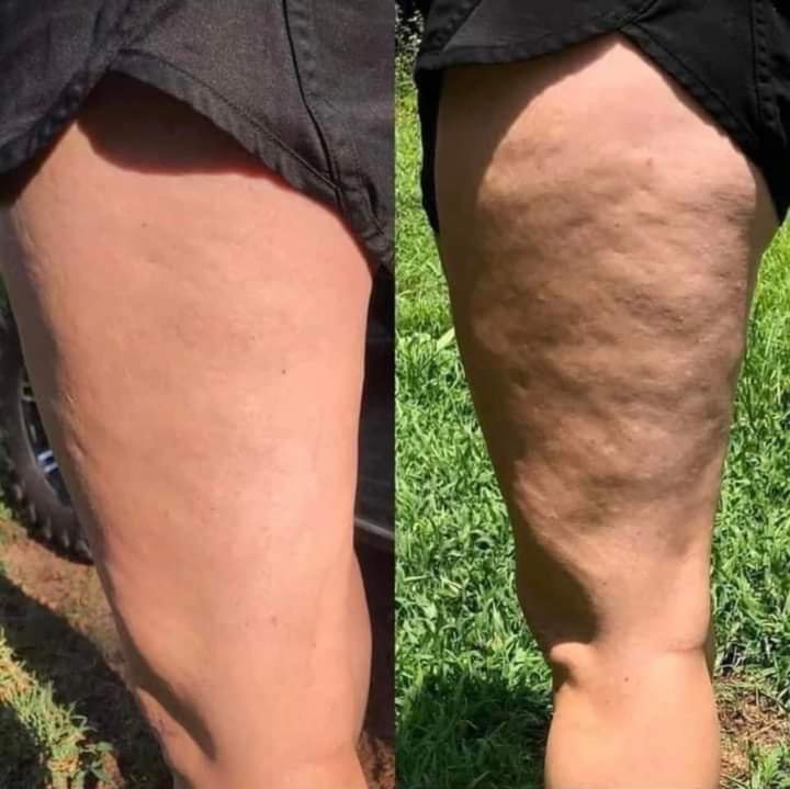 CELLULITE TREATMENT  ( 1 Session)
