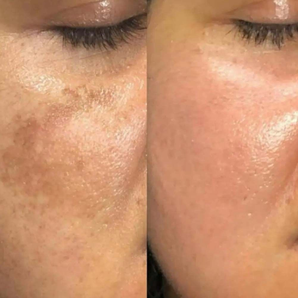 Casmara Expert Dermapeel/ Manchas at Fountain of Youth Spa in Yuma, AZ