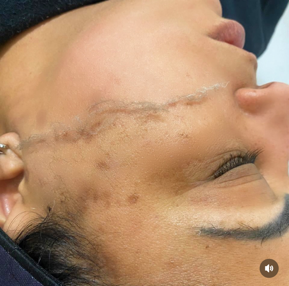 Dermaplaning Facial