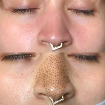 Nose Contouring