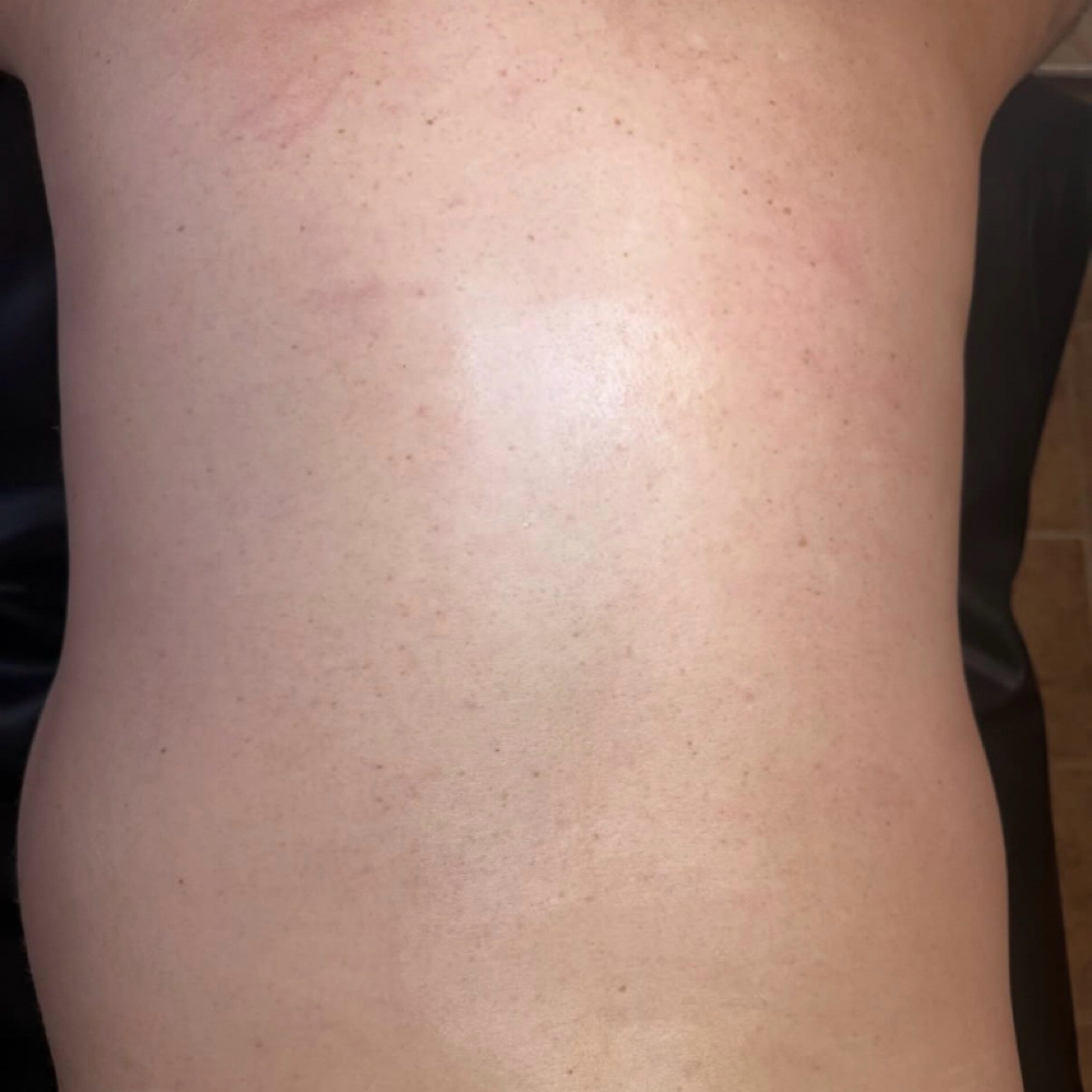 Chest, Back, & Shoulder Wax at Allure Esthetics in Kenosha, WI