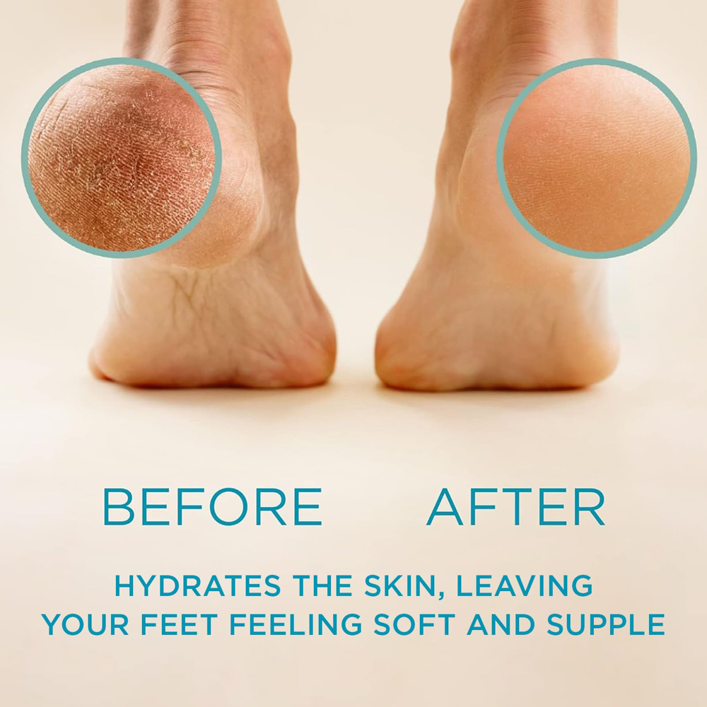Callus treatment