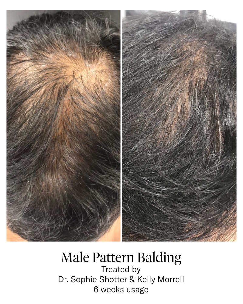Weekly Hair Growth Follow-up