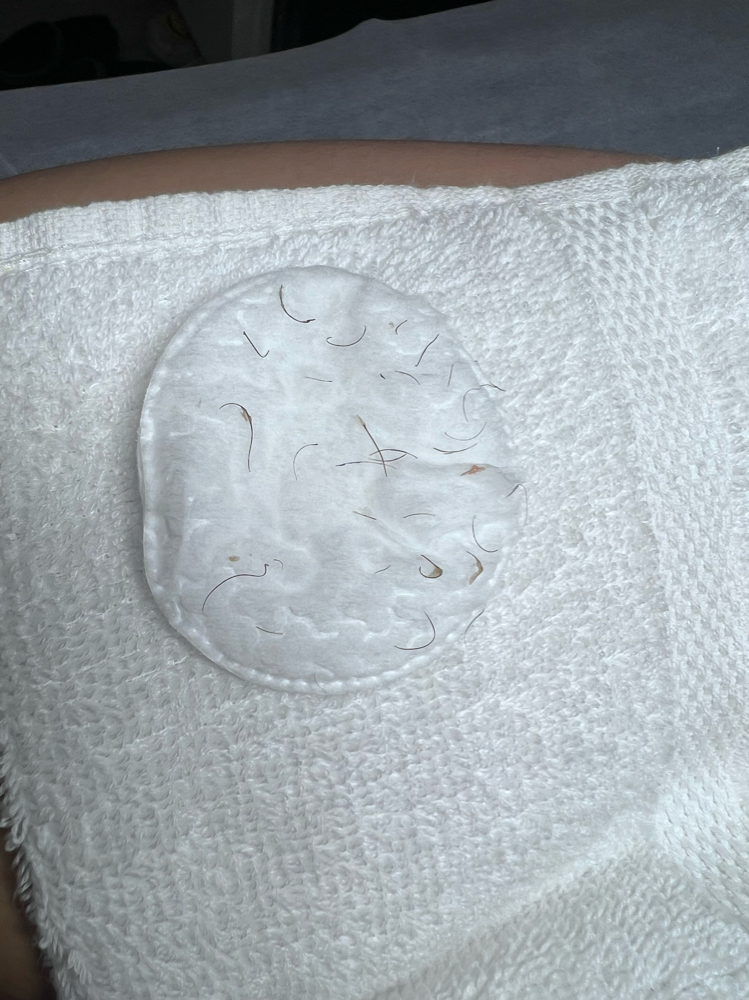 Post Brazilian Ingrown Removal