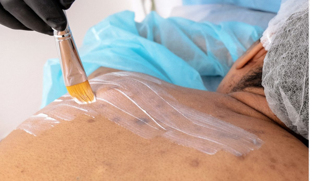 Back Facial + Chemical Peel
