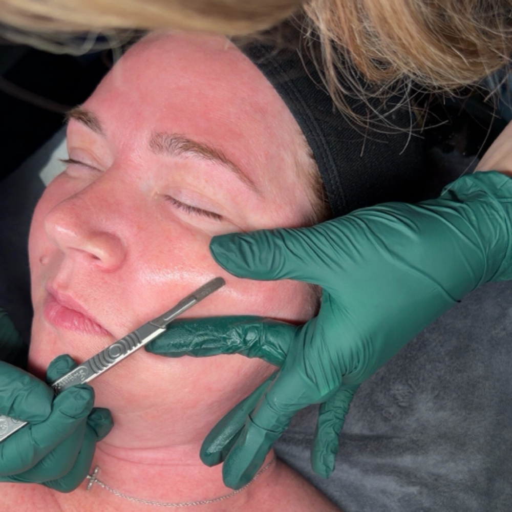 Dermaplaning & Microneedling COMBO at It's Aesthetically Jess in Swansea, IL
