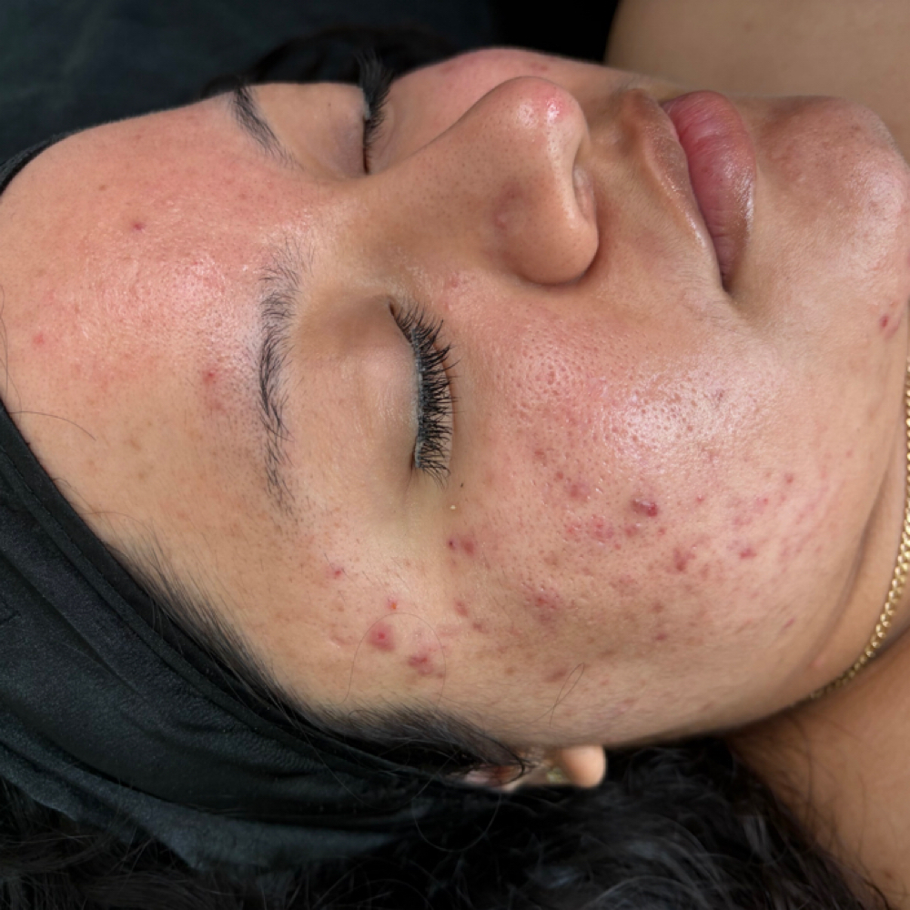Acne Facial at Urban Soul and Skin in Balch Springs, TX