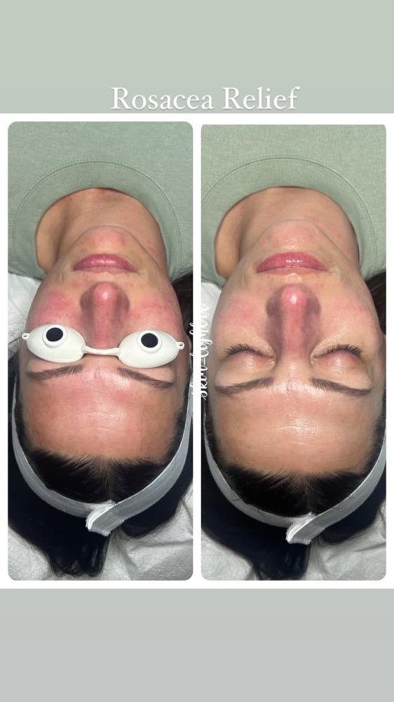 Rosacea RED face Relief Treatment