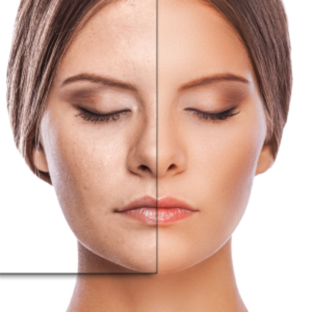 Acne Skin Tox at Holistic Beauty in View On Website, NY
