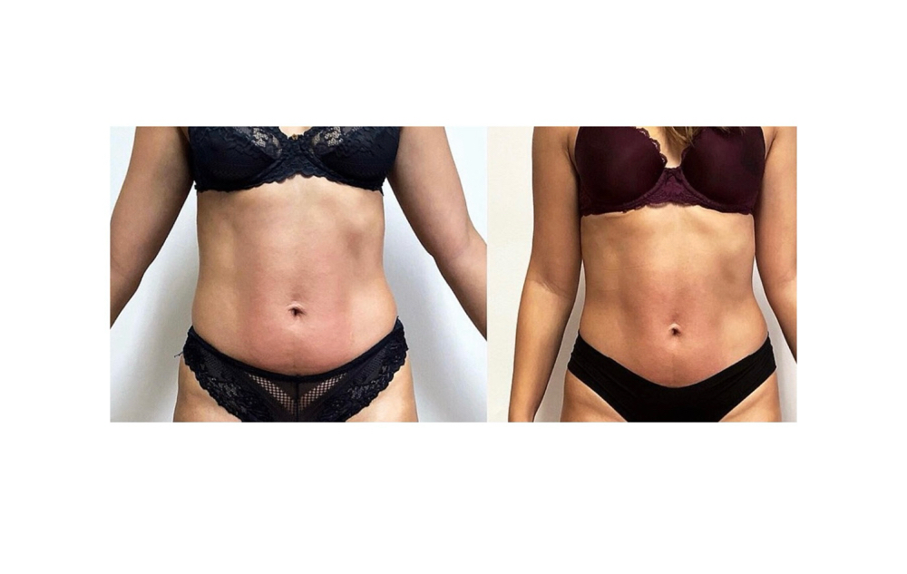 Packages Body Sculpting 7 Sessions