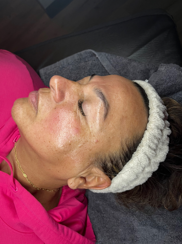 Dermaplane Facial