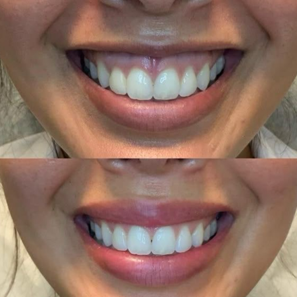 Gummy Smile at Injector Lucia in San Juan, TX