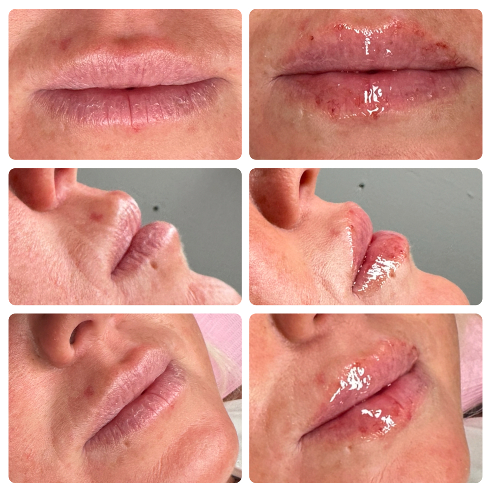 Needless Lip Filler