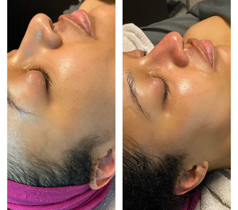 Dermaplane Facial