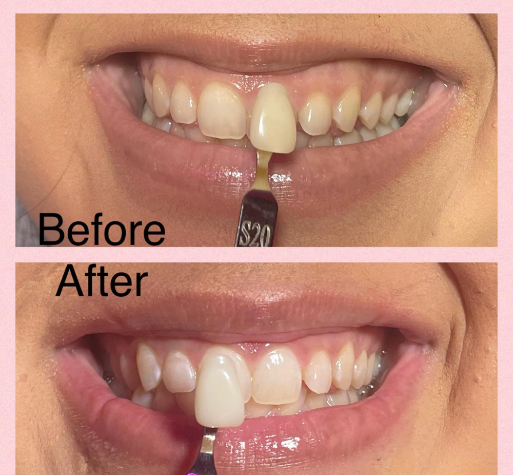 Teeth Whitening