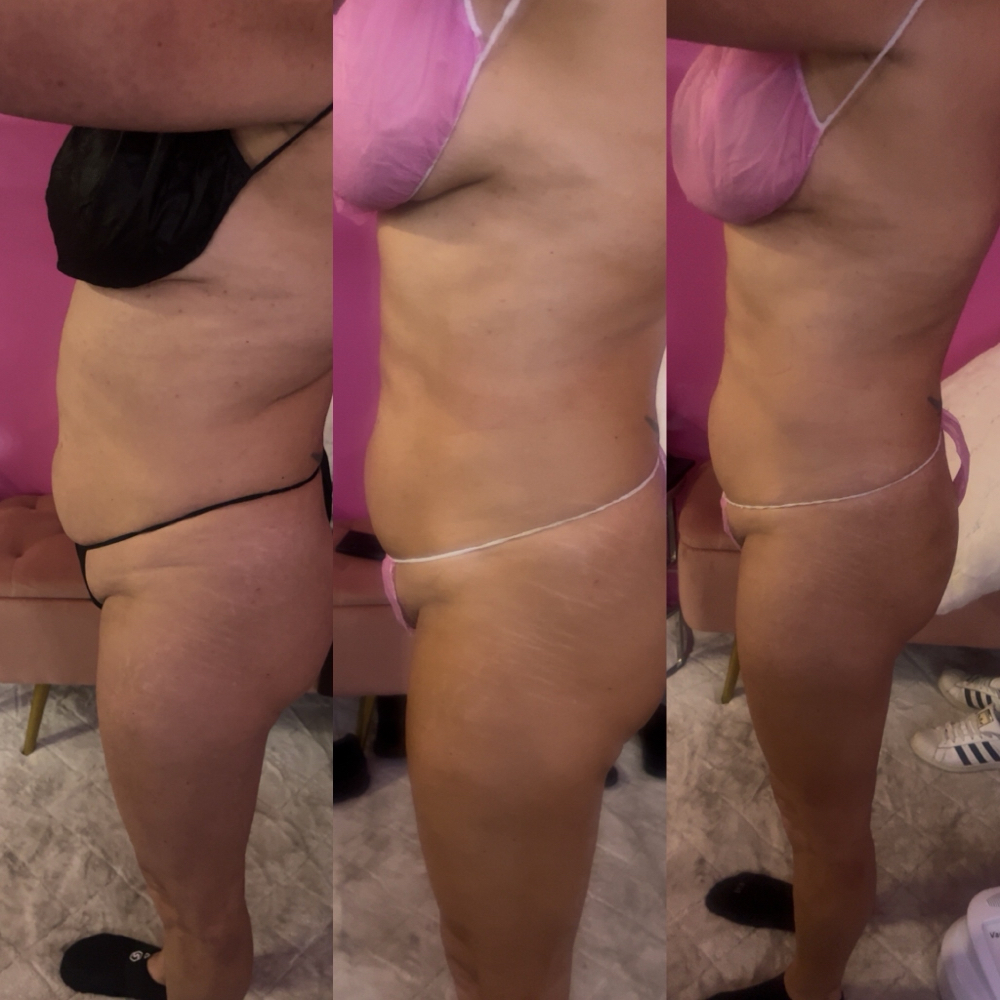 Body Sculpting