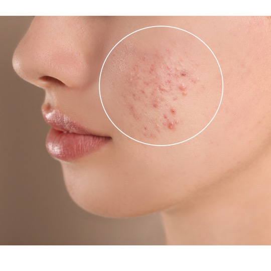 Tween Acne Facial series of 3