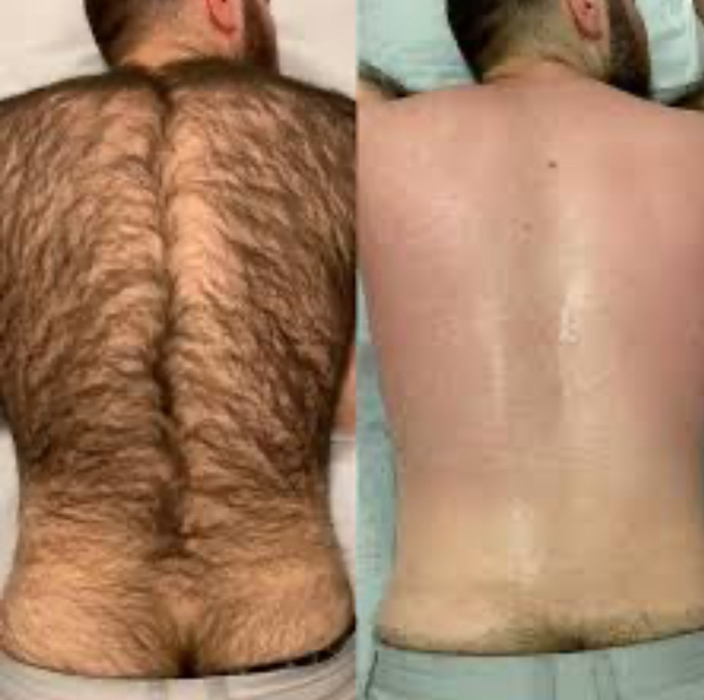 Male Back Waxing