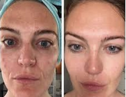 Microneedling Facial