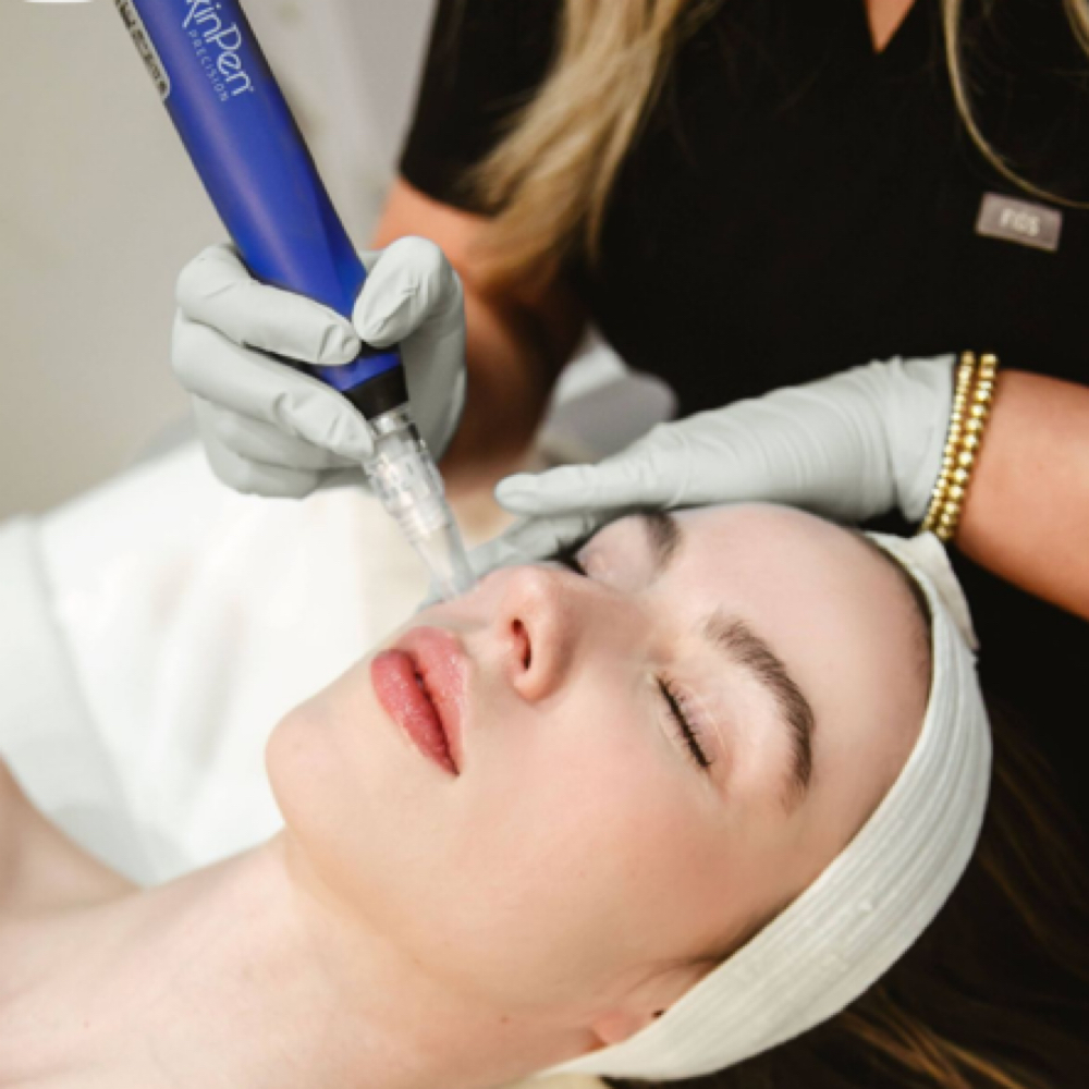 Vampire Microneedling PRP/ PLASMA at LM BEAUTY AESTHETICS in Everett, MA