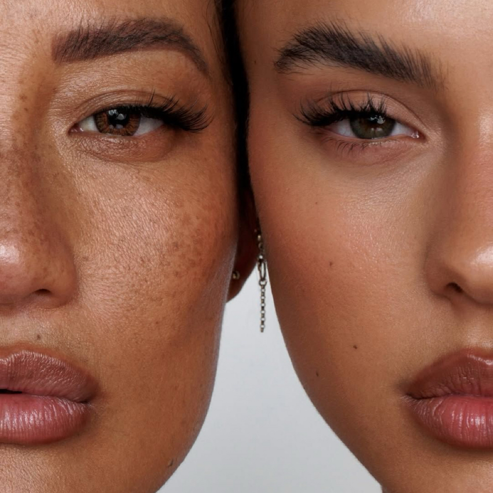 PRP Undereye Rejuvenation