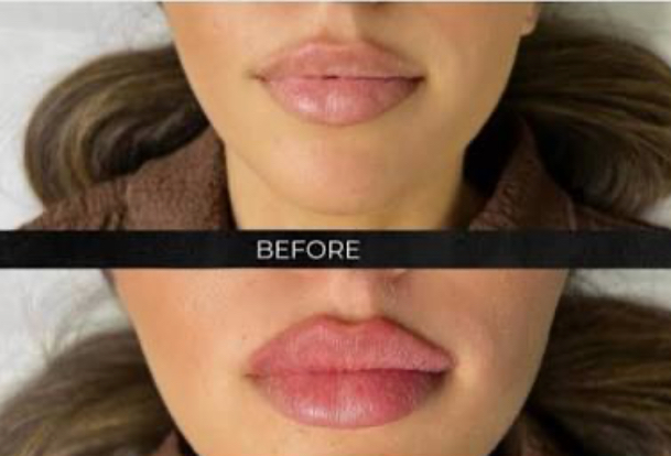 Needless Lip Filler 2ML at Ash N Aura in Crofton, MD