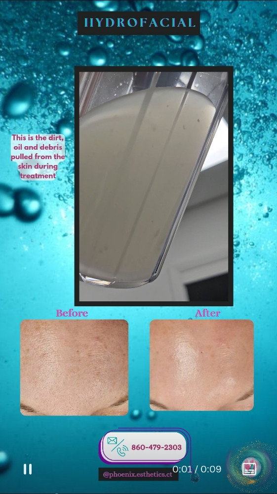 Hydrofacial Packages