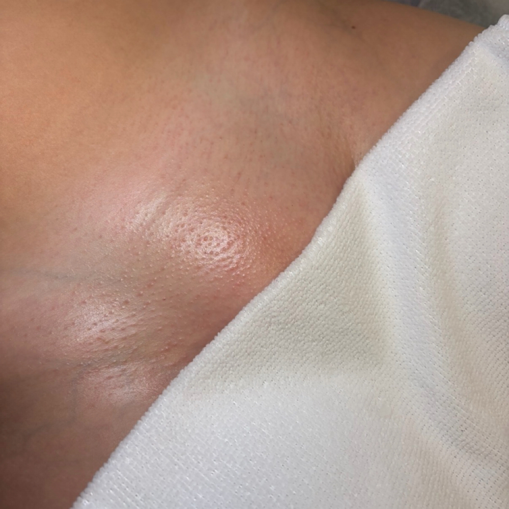 Brazilian wax (6+ Weeks Growth) at You Esthetics in Salem, MA