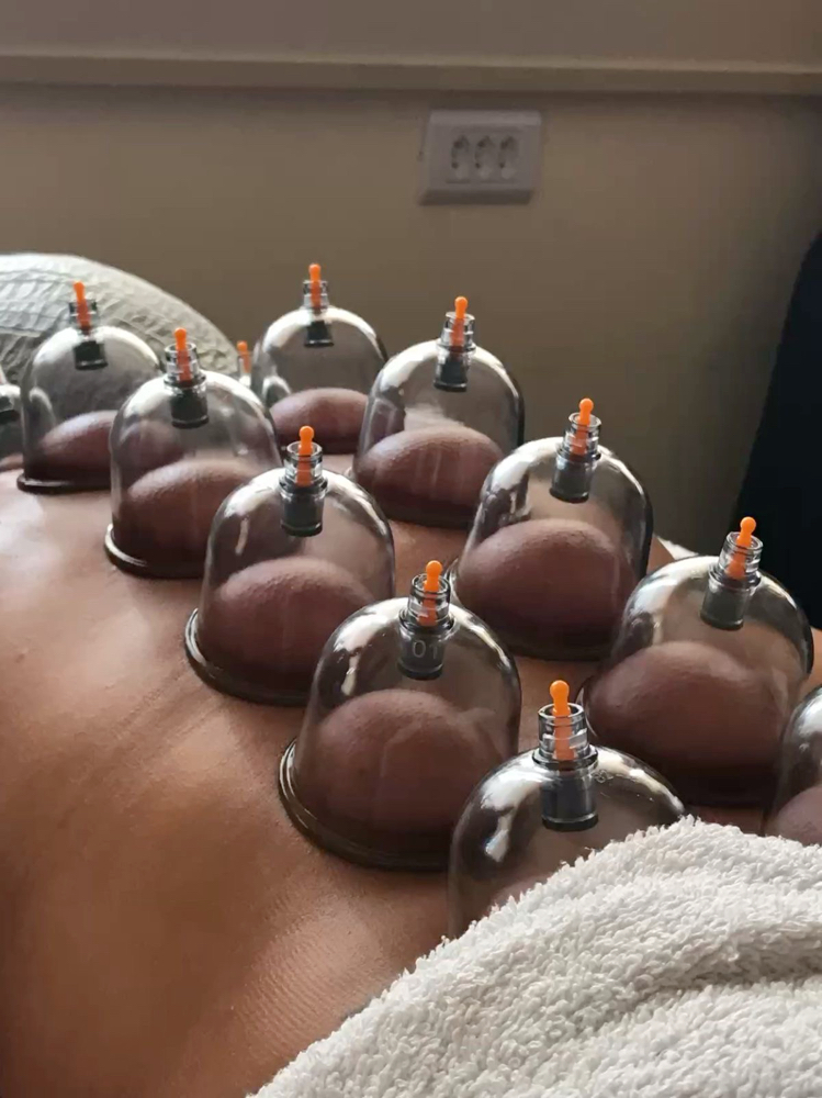 Cupping Therapy at BeautyAtEase in Palm Desert, CA