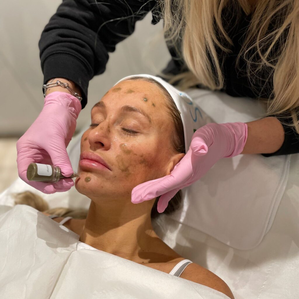 Bio Microneedling