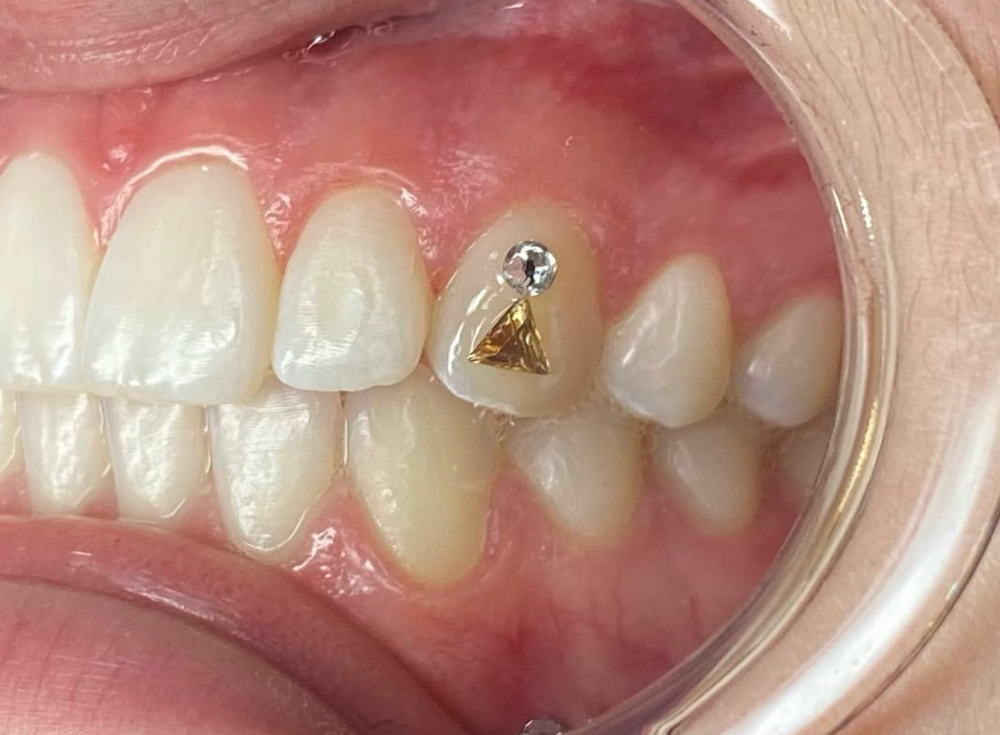 Tooth Gem (2)
