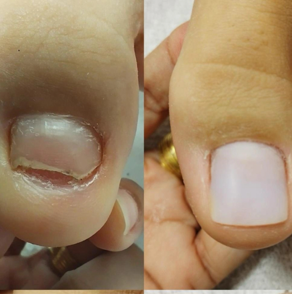BBL on 1 Big-Toe at Itz_JAMC Nails in Webster, TX