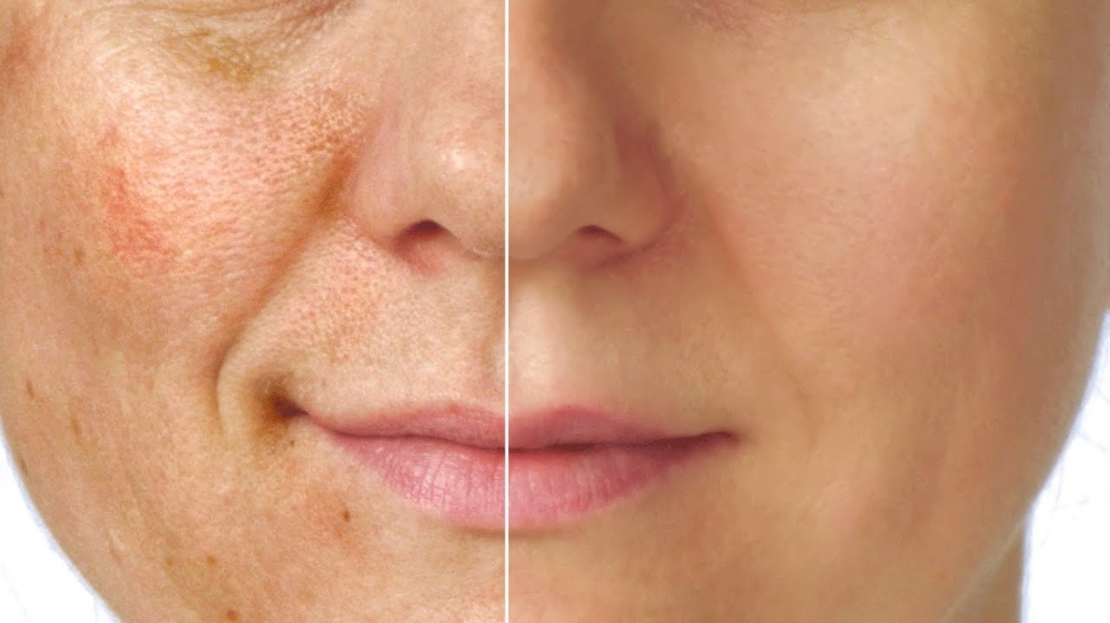 Deep C. Facial + Chemical Peel