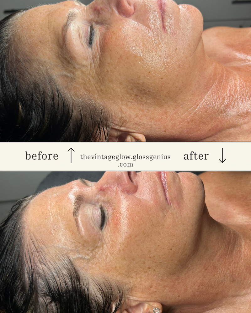 V-Tox Higher Power Lift Mask at The Vintage Glow, LLC in Norfolk, NE