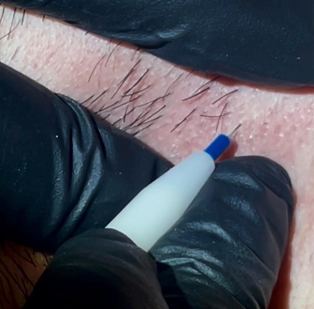 Electrolysis Consultation