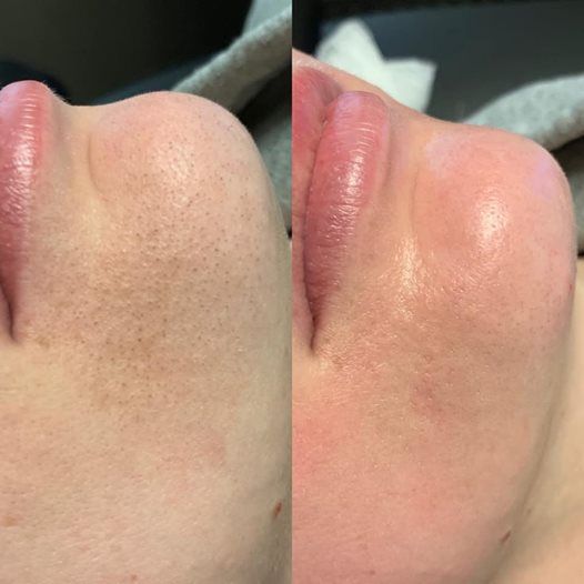 VELVET GLOW MICRODERMABRASION FACIAL