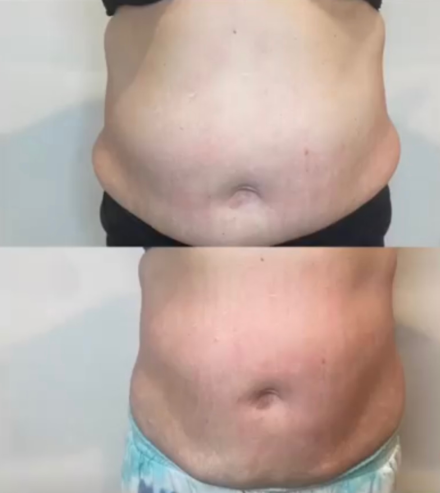 BODY CONTOURING