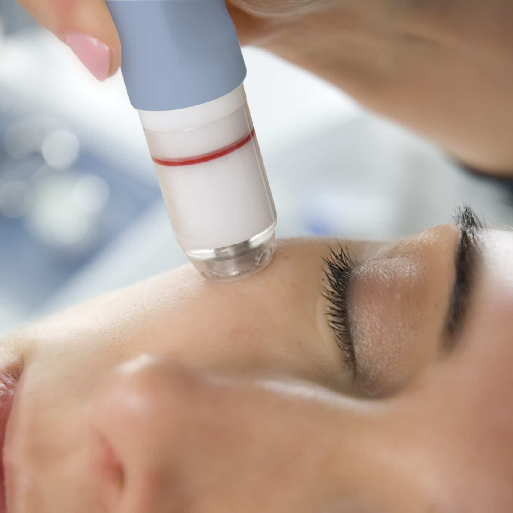 Microdermabrasion -Face - Marcia at Worthy of Wellness LLC in Winter Park, FL