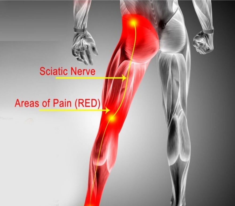 Sciatica Session ( MEDICAL MASSAGE)