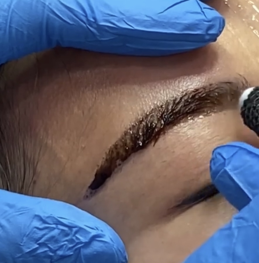 Saline Pigment Removal