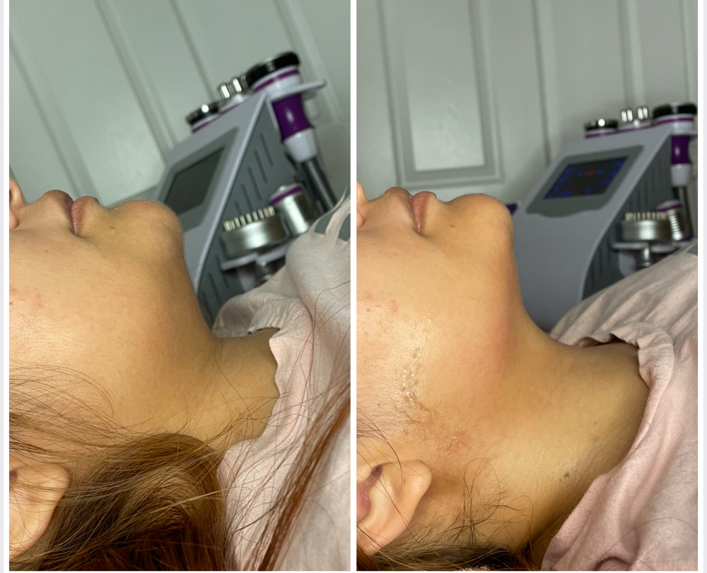 Jawline Define at Sculpted by Lluvia in Weslaco, TX