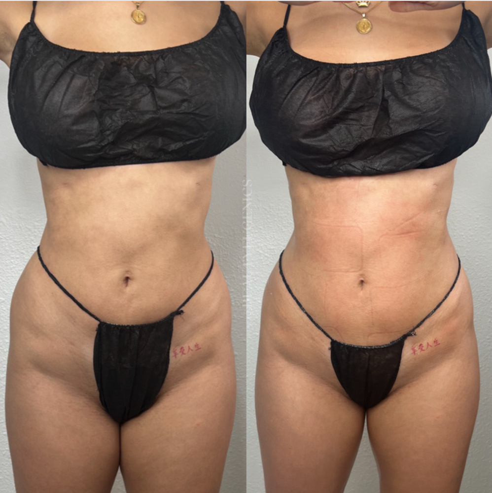 5 Full Body Body Sculpting Sessions