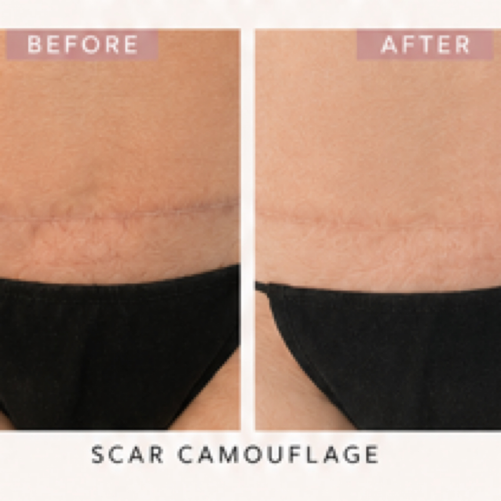 Large Scar Camouflage at Skin Theory Collective in Port Richey, FL