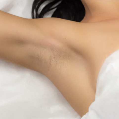 Laser Hair Removal - Small Area