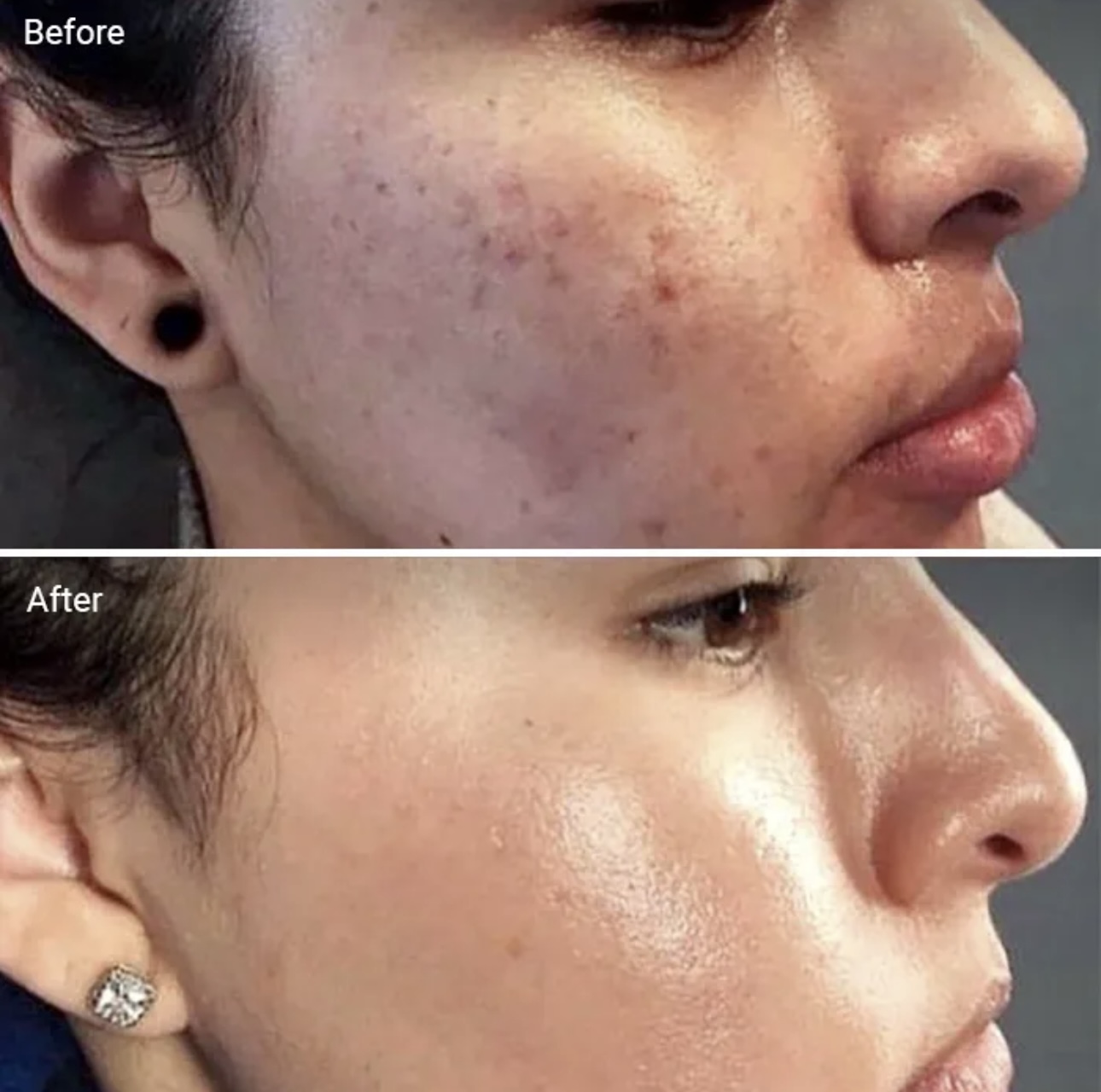 Microdermabrasion